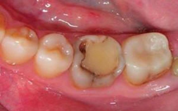 Причины и симптомы кариеса под пломбой, лечение вторичного поражения зуба