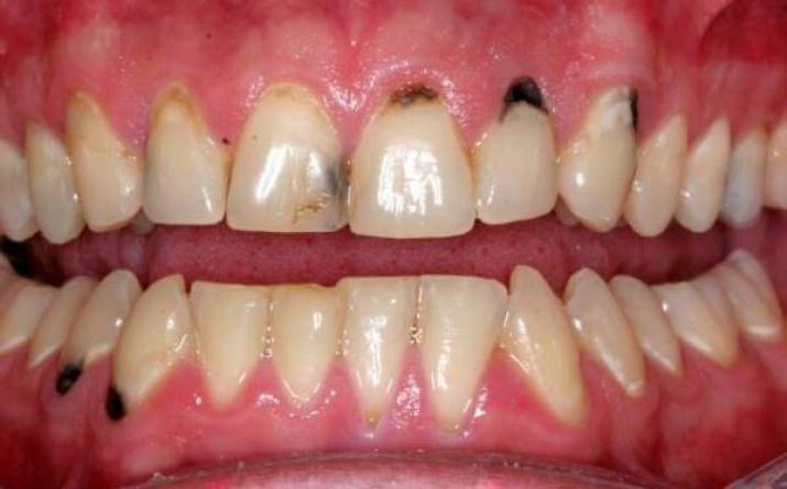 Nekrosis gigi: mengapa terjadi, bagaimana mengenalinya Pencegahan nekrosis asam pada gigi di perusahaan industri