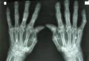 A kéz és az ujjak arthrosisa