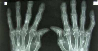 A kéz és az ujjak arthrosisa
