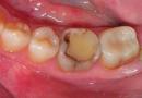 Vzroki in simptomi kariesa pod plombo, zdravljenje sekundarne poškodbe zoba