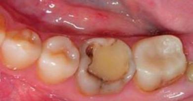 أسباب وأعراض التسوس تحت الحشوة، وعلاج تلف الأسنان الثانوي